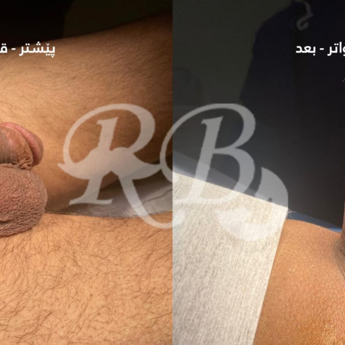 دعامات القضيب