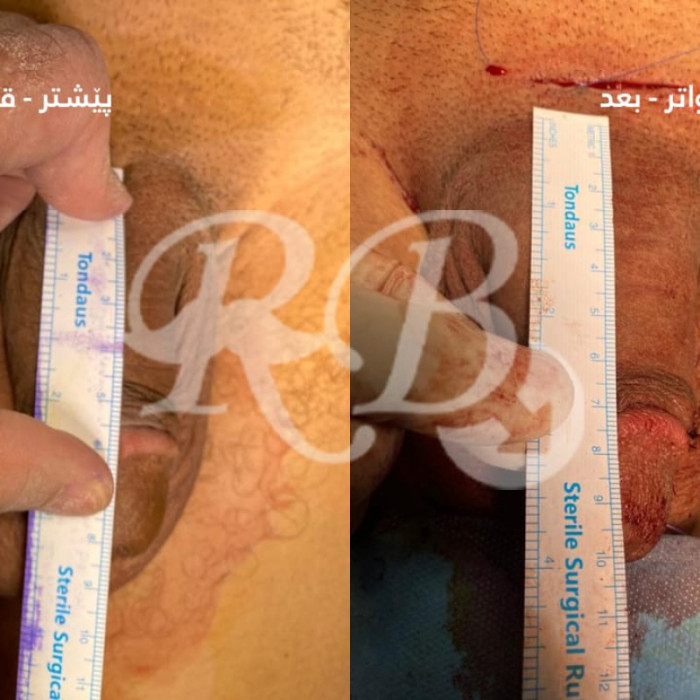 تكبير القضيب