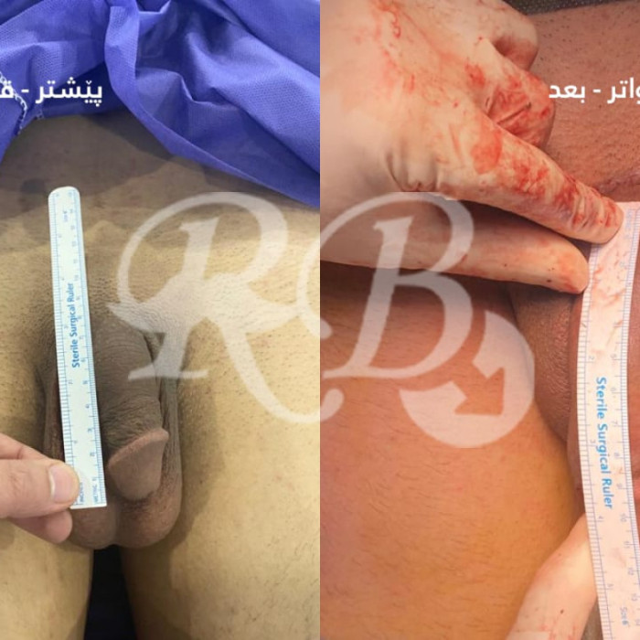 تكبير القضيب