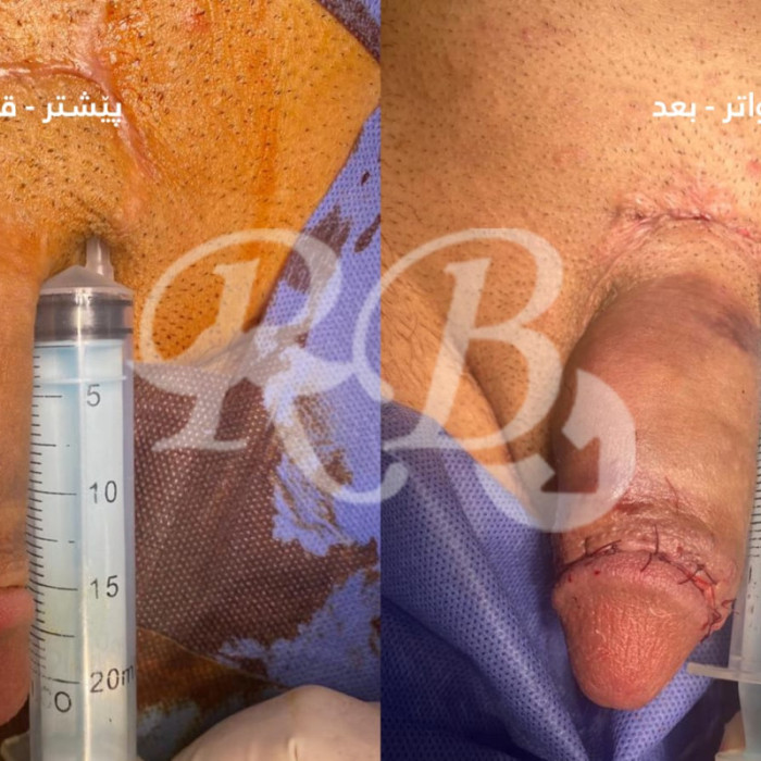 تكبير القضيب