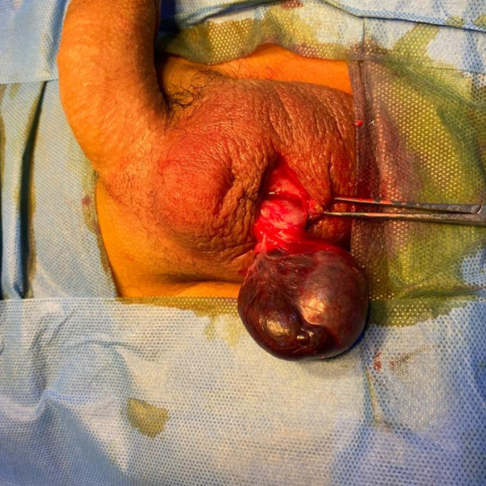 استكشاف الخصية